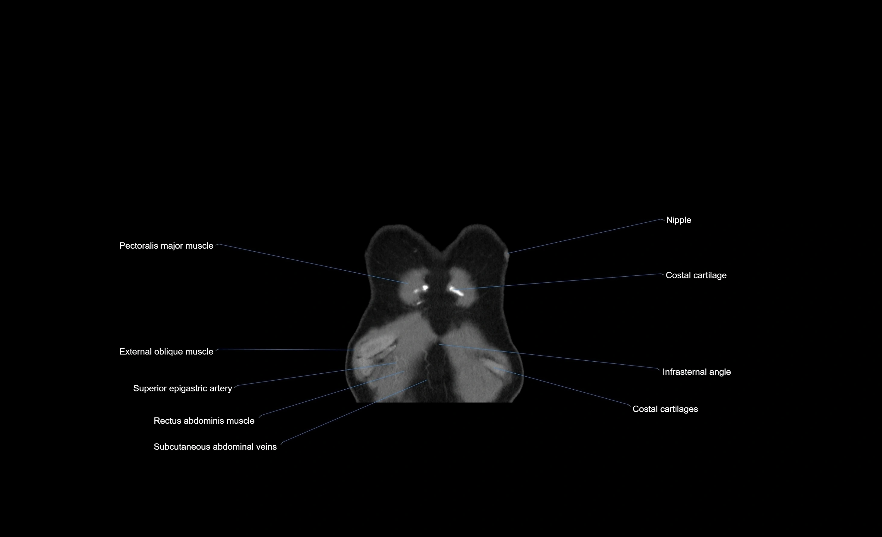 CT chest (thorax) soft tissue window labelled coronal cross sectional anatomy radiology image-00107.webp